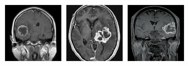 glioma gliomata neuroepistimes