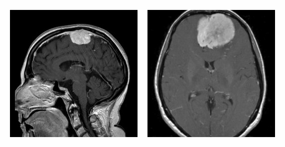 meningioma meningiomata neuroepistimes